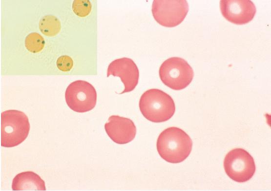 G6PD Deficiency Pathogenesis: Oxidized hemoglobin denatures and precipitates, forming intracellular inclusions called Heinz bodies, which can damage the cell membrane sufficiently to cause