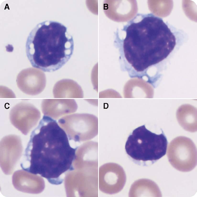 Discrete vacuoles in lymphocytes as a subtle clue to mantle