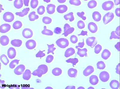 Thalassemia Major, Microangiopathic