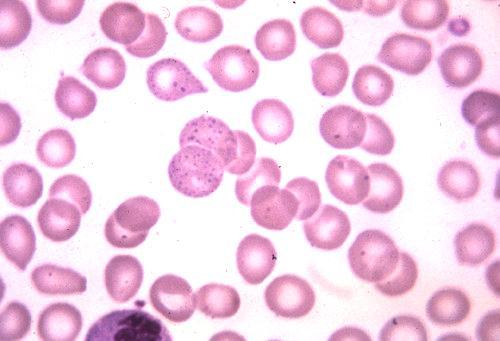 Microcytic - Thalassaemia trait Normocytic - Lead poisoning Normo
