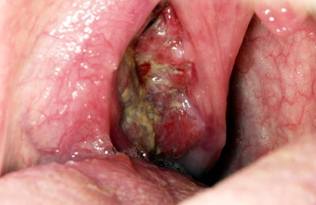 What are the warning signs /symptoms of this disease? Figure 3: Oropharyngeal squamous cell carcinoma (OPSCC) presenting as an ulcero-proliferative growth in the posterior tonsillar area.