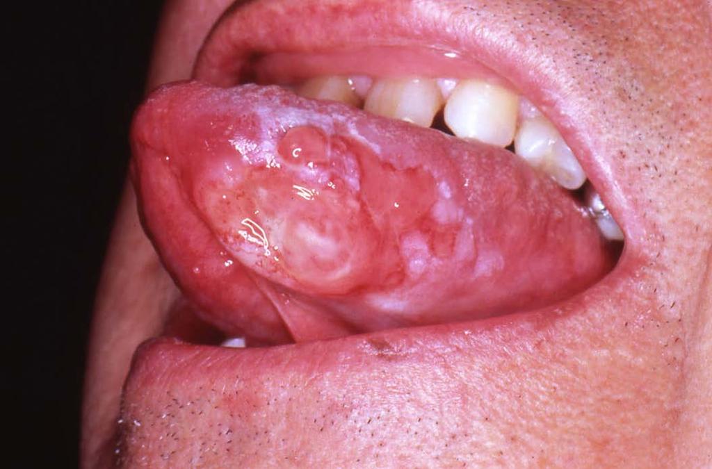 Can HPV cause OSCC in oral cavity? Figure 5: Oral squamous cell carcinoma (OSCC) presenting as an ulcer in the anterolateral and ventral portion of the tongue. Courtesy: Dr.