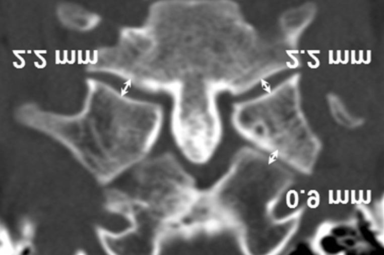 (B) Basiondens interval of 4.93 mm and (C) anterior atlanto-dens interval of 1.22 mm.