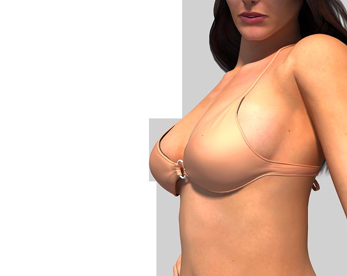Breast Augmentation - Saline Implants Breast augmentation, or augmentation mammoplasty, is one of the most common plastic surgery procedures performed today.