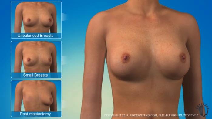 Introduction Breast augmentation, or augmentation mammoplasty, is one of the most common plastic surgery procedures performed today.