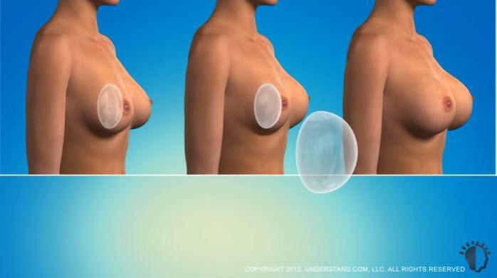 Implant Options A variety of breast implant options exist. Breast implants differ by shape, texture, and profile. Breast implants may be round or contoured, and may have a smooth or textured surface.