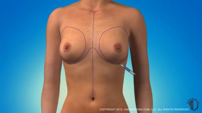 Preparation Breast augmentation procedures typically last approximately one to two hours.
