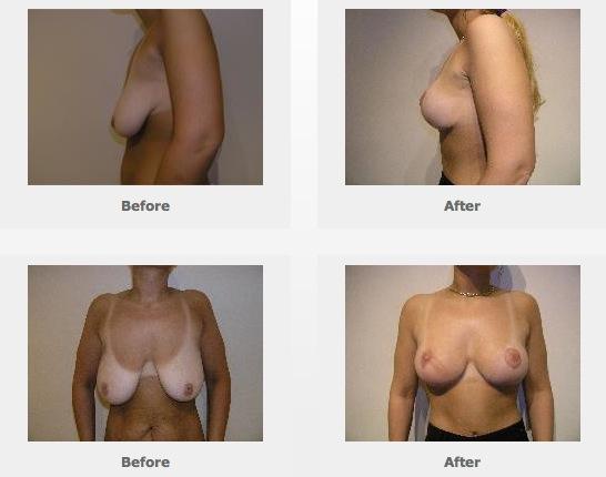 THE PROCEDURE Breast Lift (Mastopexy) Houston A Breast Lift is performed in an accredited surgery center under general anesthesia.