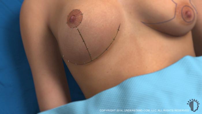 Procedure The physician carefully makes incisions along the pre-marked lines. The upper incision extends above the border of the areola. This area marks the new upper edge of the areola.