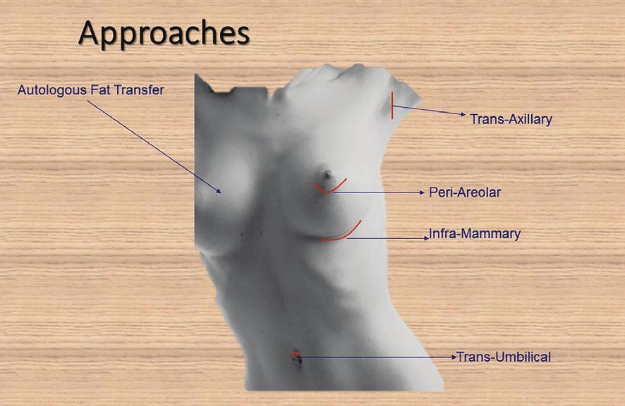 Ahmad 357 INTRODUCTION Breast augmentation is an elective surgery used to increase the size of the breast in females.