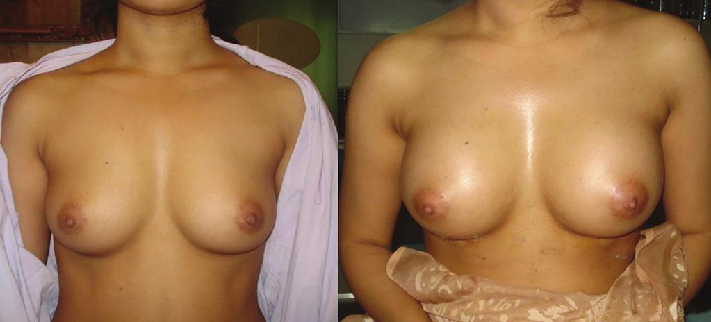 358 Breast augmentation in Pakistani females Saline-filled implants were used in 30.2%, whereas gel-filled implants were used in 69.8% of patients. The average implant volume of 278.