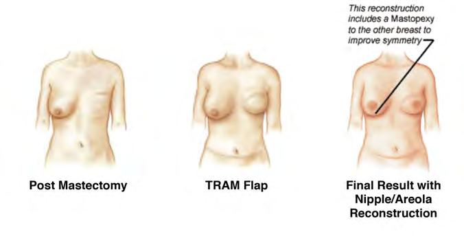 The most common types of tissue flaps are the TRAM (transverse rectus abdominus musculocutaneous flap) (which uses tissue from the abdomen) and the Latissimus dorsi flap (which uses tissue from the