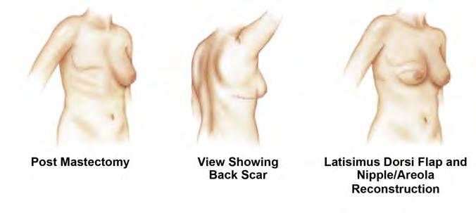 30 THE LATISSIMUS DORSI FLAP WITH OR WITHOUT BREAST IMPLANTS During a Latissimus Dorsi flap procedure, the surgeon moves a section of tissue from your back to your chest to reconstruct the breast.