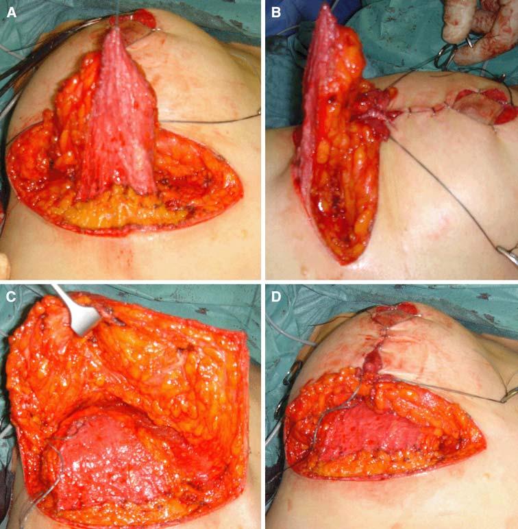 Aesth Plast Surg (2009) 33:302 307 303 Table 1 Pre- and postoperative evaluation of the NAC positioning (n = 27) Distance Preoperative (cm) After 6 months (cm) After 12 months (cm) N-SN 25.2 ± 0.9 20.