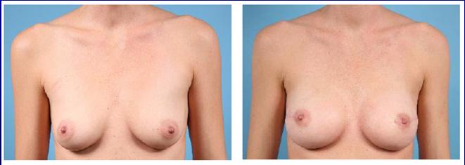 Staged (tissue expander) Sub-pectoral vs.