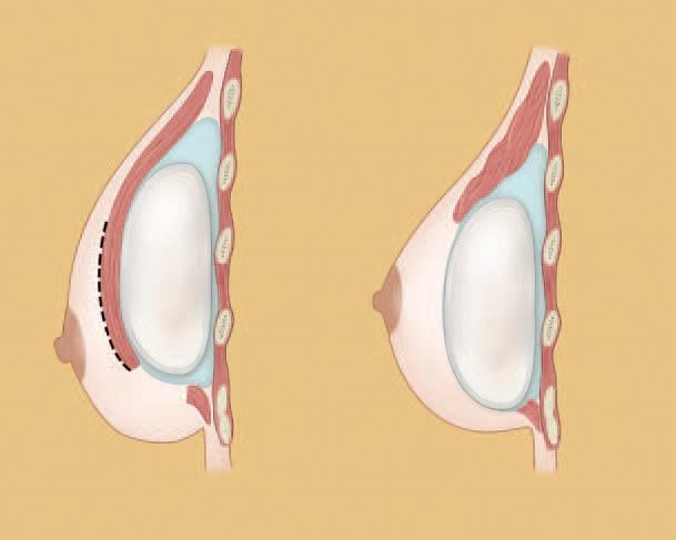 1. Usually bothered by the size of the breasts. 2. Important parameters in pre-operative evaluation a. Base width: width of the breast on the chest wall b.