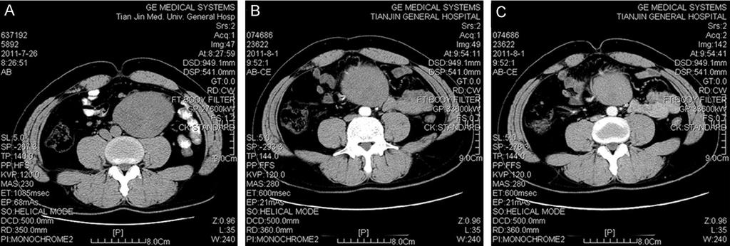 Figure 1. Abdominal CT scan demonstrated well-defined and large mass within the abdominal cavity.