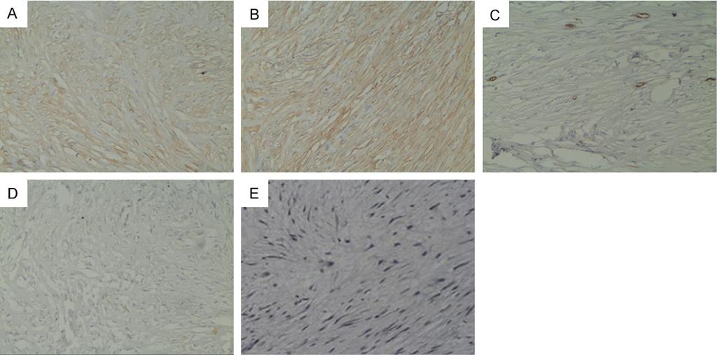 Immunohistochemical: Diffuse strong positivity for CD99 (A); Diffuse strong positivity for SMA (B); Multi focal positivity for CD34 (C); bcl-2 (negative) (D); mitotic index less than 4 mitoses/ HPF