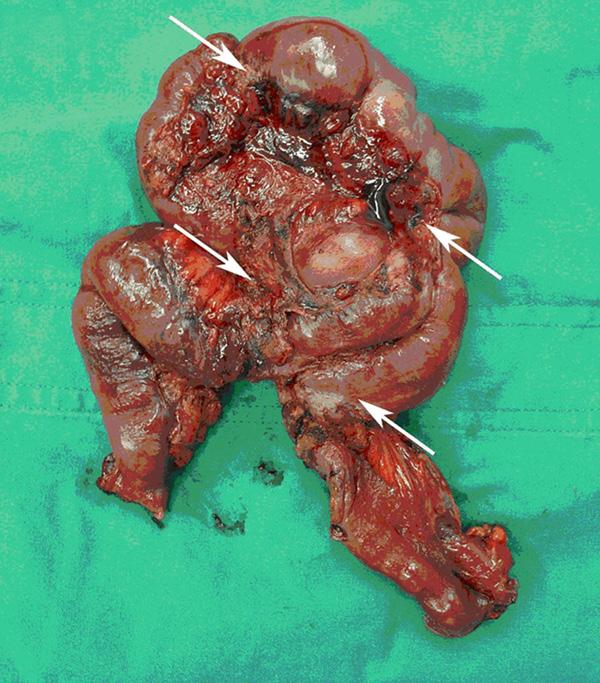 (White arrow). Figure 6. Second post operative Specimen showed multiple strictures in the small bowel mainly aggregated around the mesenteric segment (white arrow). aggregated bowel mass, 1.