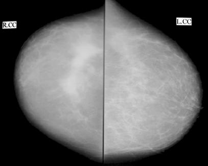 (BIRADS 5) in the axillary tail of the left breast. (C) (D) (E) Fig.