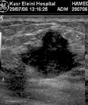 edema pattern Skin thickening Mammography 30 14 53 5 28 20 3 Ultrasound 111 14 2 2-20 3 Total 152 152 * Typical