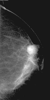 Missed Breast Carcinoma 183 Fig.