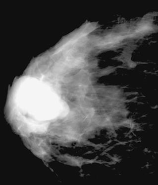 the mammogram of a 70-year-old female.