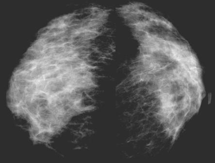 Missed Breast Carcinoma 185 Fig.
