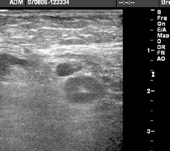 edema was detected with overlying skin thickening associated