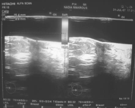 (11): Negative mammogram in a 44-year-old presented with nipple ulcer.