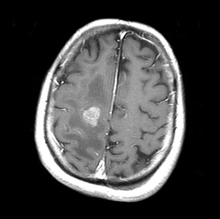 Our patient: Intracranial hemorrhage on C+ MRI MRI head T1/ C+ Moderate degree of lesion enhancement