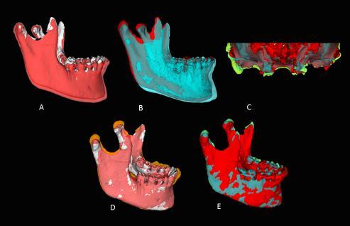 Figure 3 - A. T1 (white) to T2 (red) mandible registered on the anterior cranial base showing anterior projection of B-