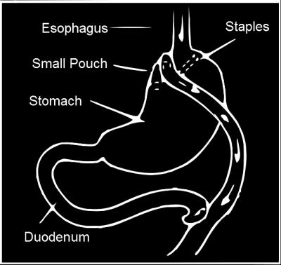 An upper gastric pouch and a lower gastric remnant is formed from the stomach. The jejunum is divided and anastomosed to the gastric pouch. The distal jejunum is brought up as a 'Roux-limb'.