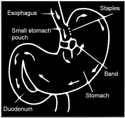 Diagram of a vertical banded gastroplasty where a part of the stomach is permanently stapled to