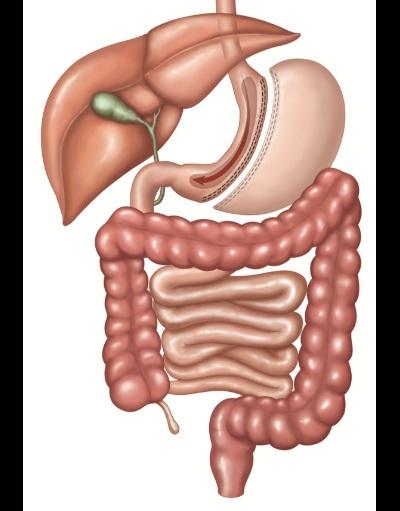 The stomach is transected vertically creating a gastric tube and leaving