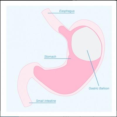An illustration of the gastric balloon weight loss procedure where the