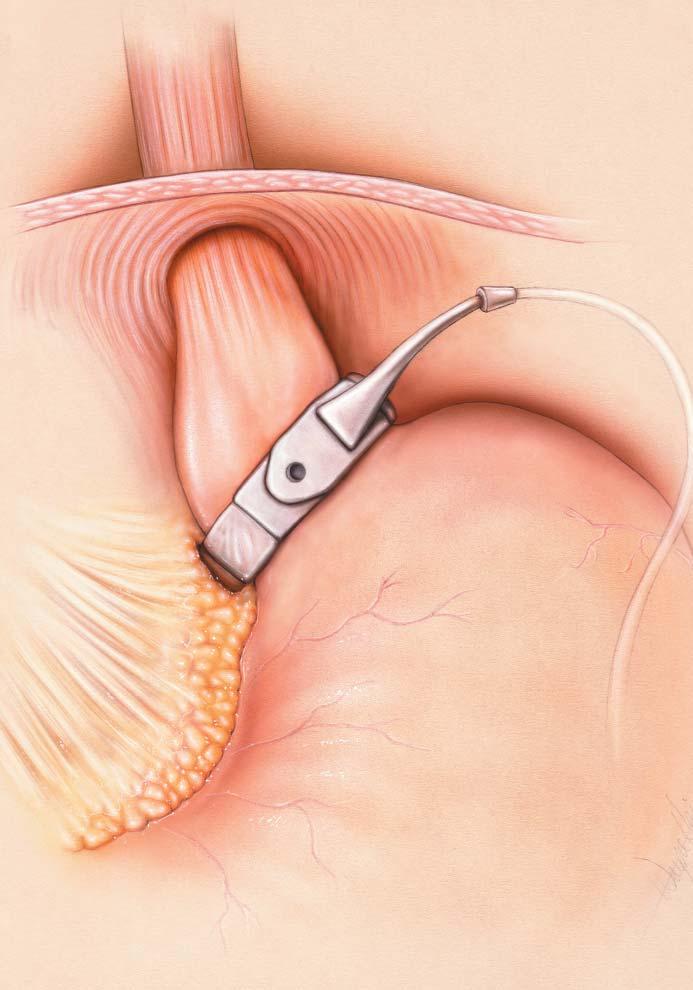 LAPAROSCOPIC ADJUSTABLE GASTRIC BAND (LAP-BAND) Band is placed around upper part of stomach - laparoscopic No division