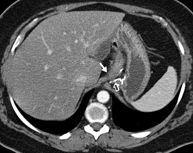 Transverse CT images show normal postoperative anatomy in the gastrointestinal tract, including (a) a small gastric pouch (solid