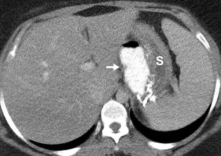Small-bowel obstruction caused by stenosis of the jejunojejunal anastomosis in a 27- year-old woman 10 days after gastric bypass surgery.