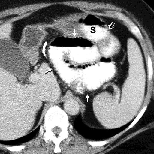Transmesocolonic internal hernia in a 50-year-old woman 3 months after gastric bypass