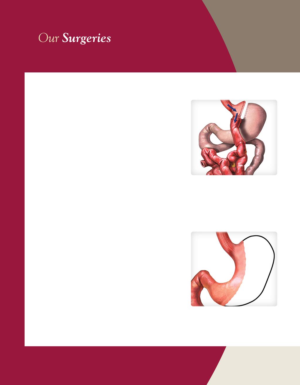 Laparoscopic Gastric Bypass Laparoscopic gastric bypass is the most frequently performed weight loss surgery in the United States.