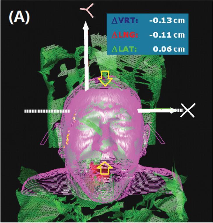 IMPROVES SETUP ACCURACY Optical Imaging and CBCT-guided frameless