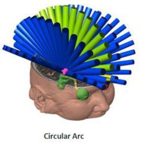 Linac SRS Treatment Options Use it for small symmetrical targets, e.g. trigeminal neuralgia, metastases, etc.