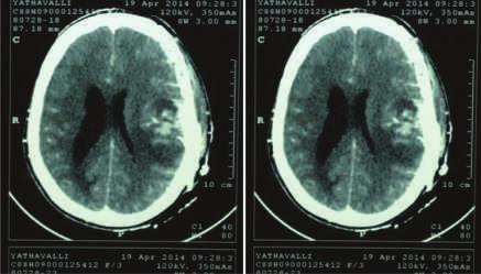 Twenty five operated cases of intracranial meningiomas have been analyzed in this study and correlation has been made between MRI appearance and intra-operative consistency and MRI and the