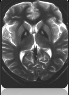 Neurodegeneration with brain iron accumulation