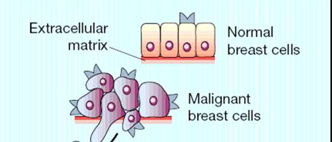 Chemokines in breast cancer: the