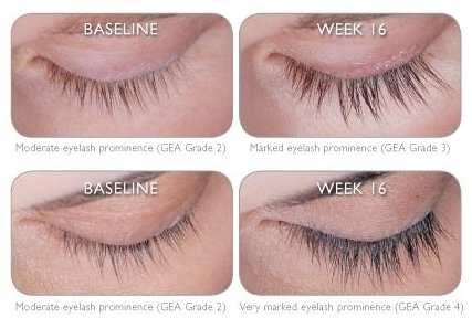 LATISSE Latisse (bimatoprost ophthalmic solution 0.03%) is the first and only FDA approved medication to aide in growing longer eyelashes.