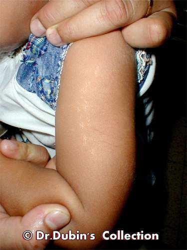 Lichen Striatus Lichen striatus is an uncommon form of a skin condition that usually occurs in children.