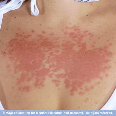 POLYMORPHOUS LIGHT ERUPTION (PMLE) Polymorphous light eruption is a long confusing name for a common skin problem that occurs as a result of sensitivity to sunlight. It is a type of sun allergy.