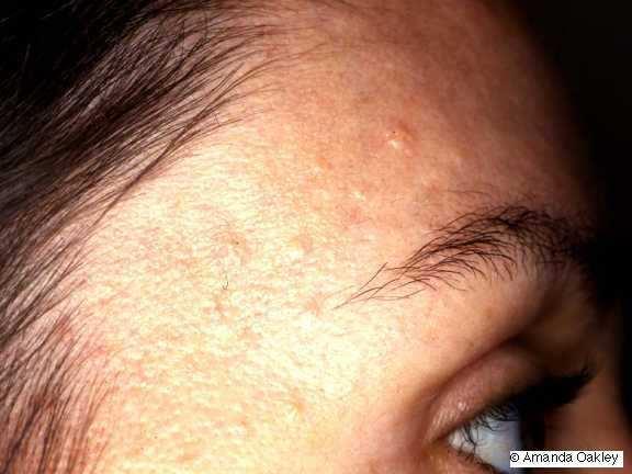 SEBACEOUS HYPERPLASIA Sebaceous hyperplasia are small benign growths usually located on the facial skin. They represent small oil gland overgrowths.